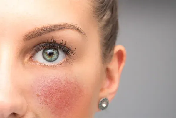 Close-up of a woman with rosacea on her cheeks. Schedule treatment for rosacea from Tanya Zboril, NP of TBT Medical in Regina.